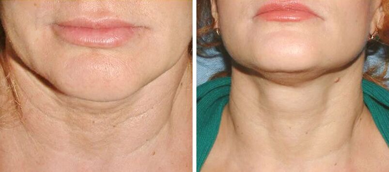 before and after laser skin resurfacing photo 2