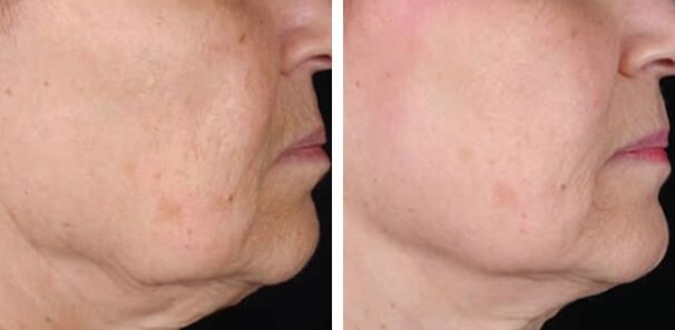 before and after laser skin resurfacing photo 3