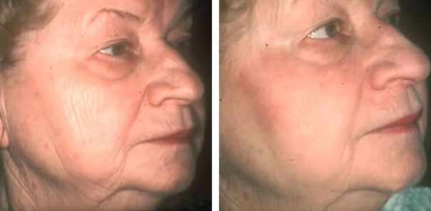 before and after laser skin resurfacing photo 4