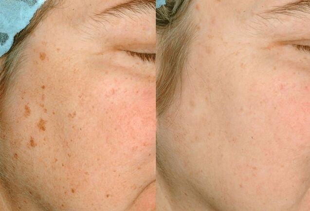 Remove skin pigmentation