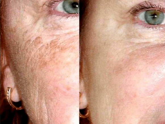 Peeling