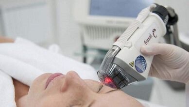 How is fractional skin resurfacing performed